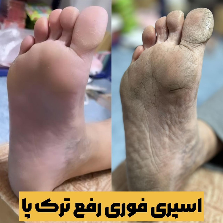 اسپری ترک پا رفع پینه پا از بین برنده ترک کف پا و قوزک پا لایه بردار روشن کننده و شفاف کننده پوست اسکراب پا ویتامین سی